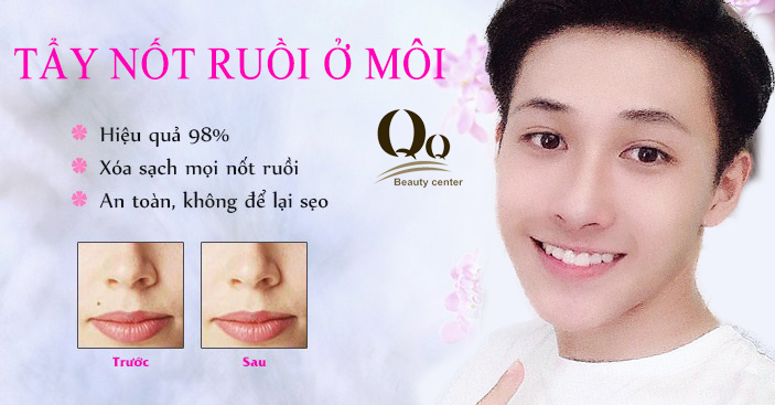 Tẩy nốt ruồi ở môi