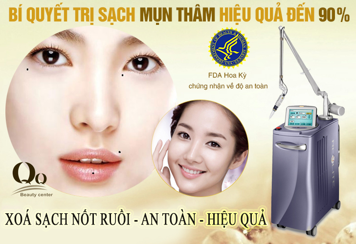 Xoá sạch nốt ruồi bằng Laser