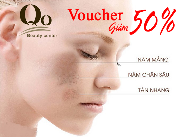 Voucher trị nám da  ở Hà Nội