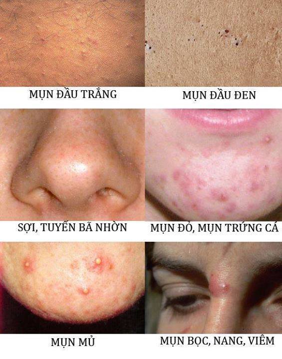 cac loại mun trung ca