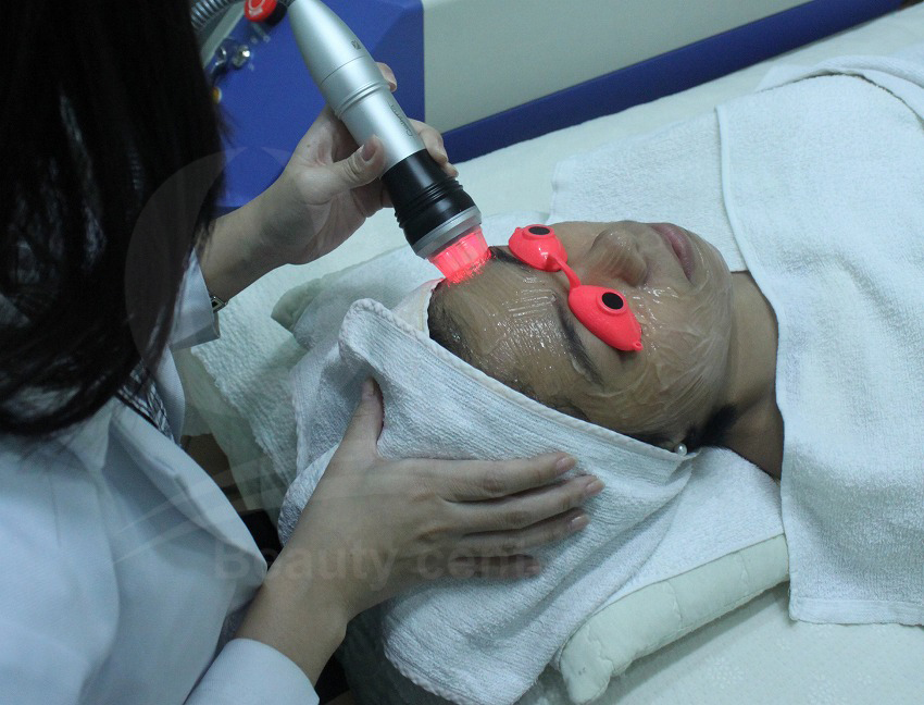 Cong nghe laser acnes