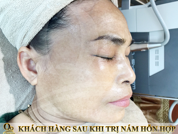 Tri nam bang tia laser co hieu qua khong