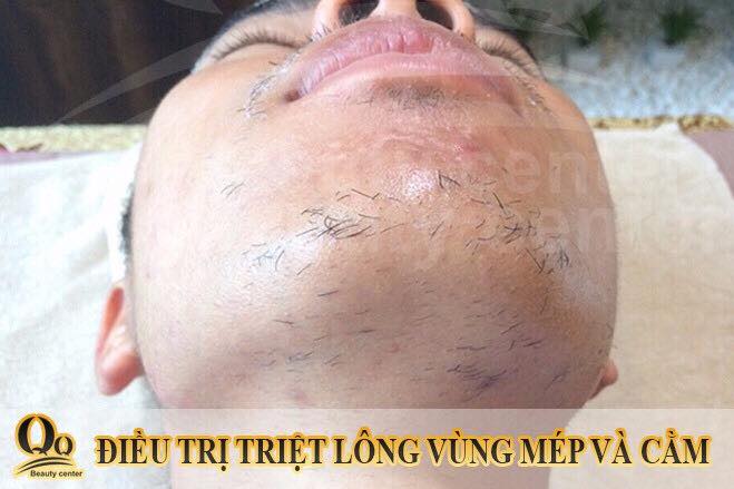 triet long mat vinh vien cho nam