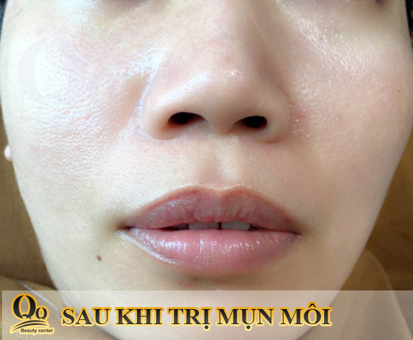 mua thuoc anti sebum o dau