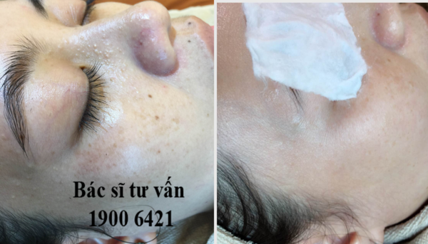 Trị nám bằng tia laser